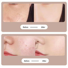 Facial Freckle Dark Spot Remover  Skin Care Beauty Device