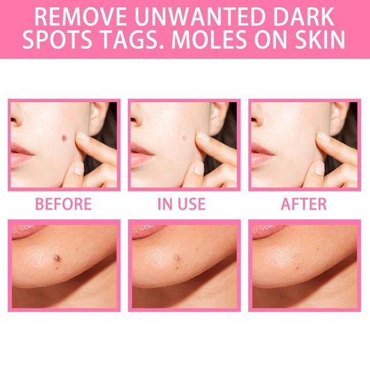Organic Tags Solutions Serum No Trace Painle Skin Tag Remover Serum Mole Removal Cream Painless Face Wart Mole Freckle